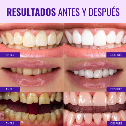 Blanqueador y Corrector de Color V34 VitalSmile™